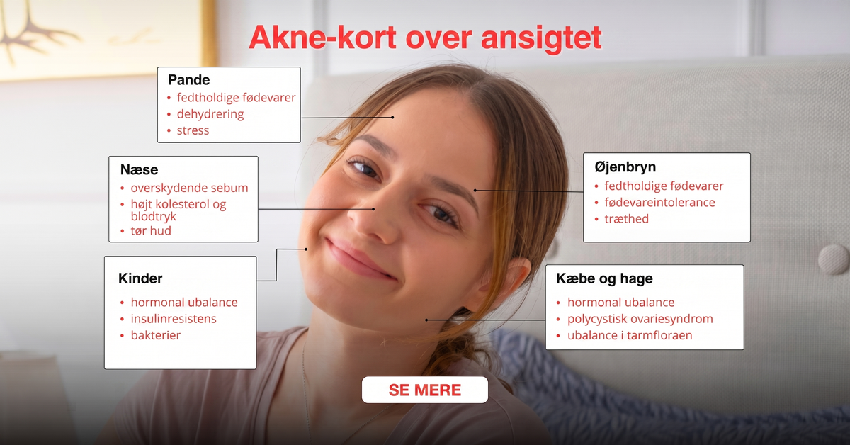 Ansigtskort ved akne i zoner