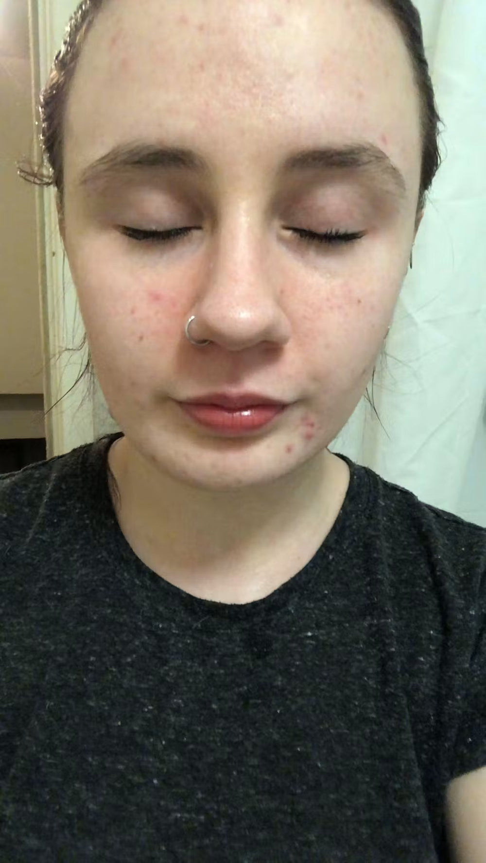 acne DK keep