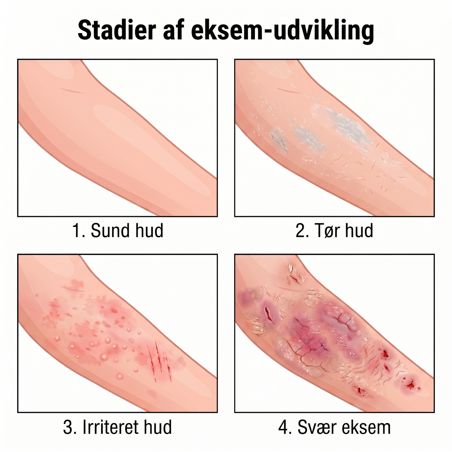 eczema_DK_eczema_4stages_v2.png