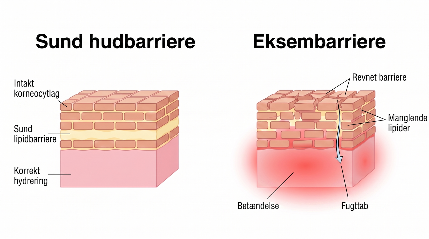 eczema_DK_skin_barrier_v2.png