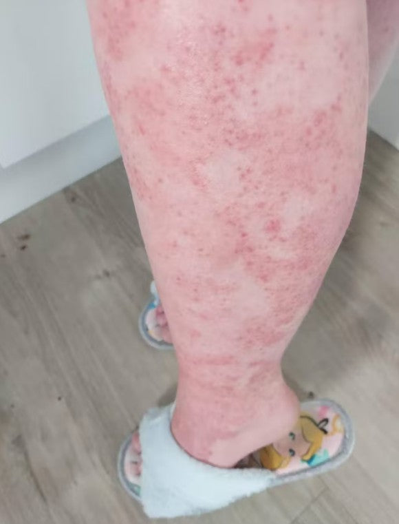 eczema_leg_before.jpg
