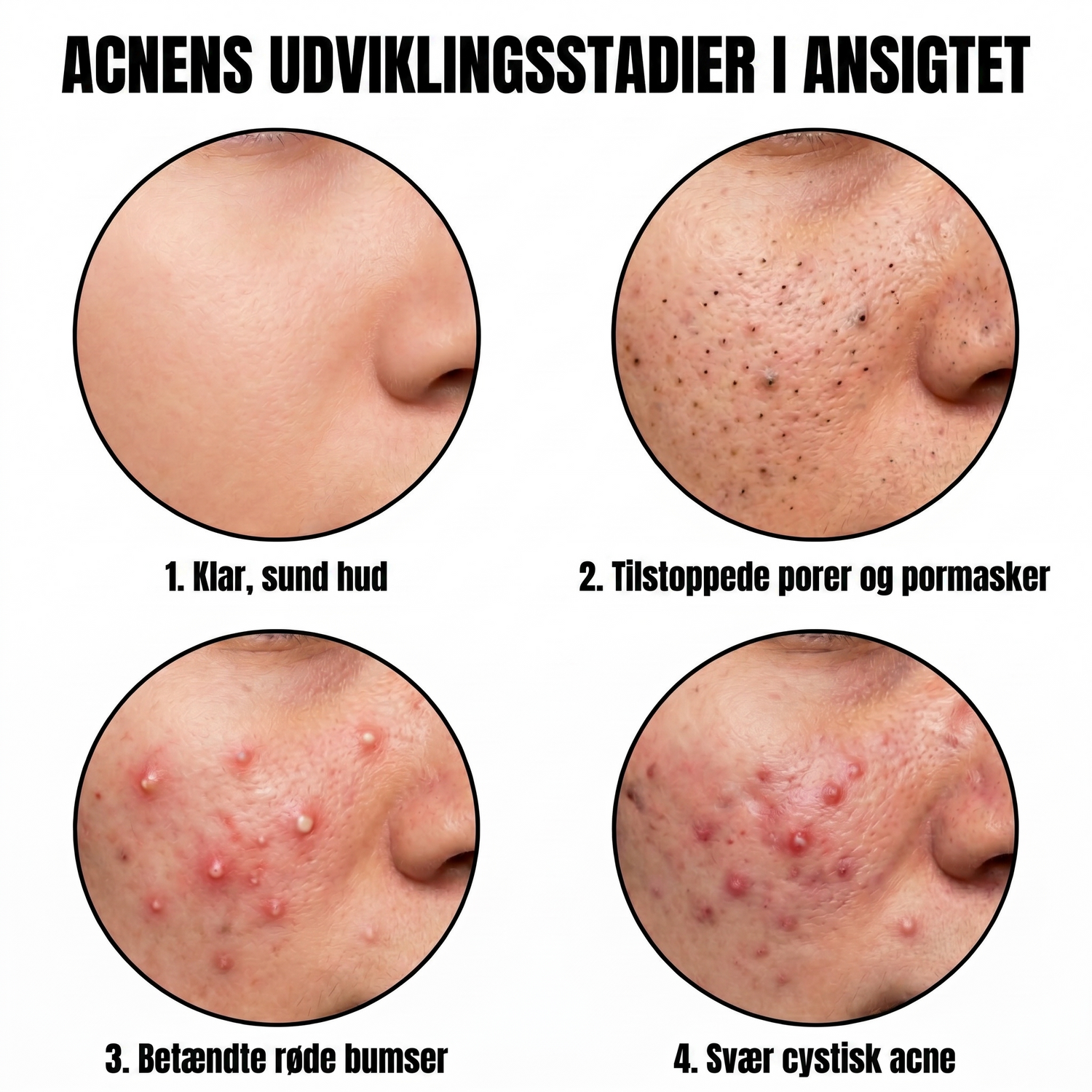acne DK translated